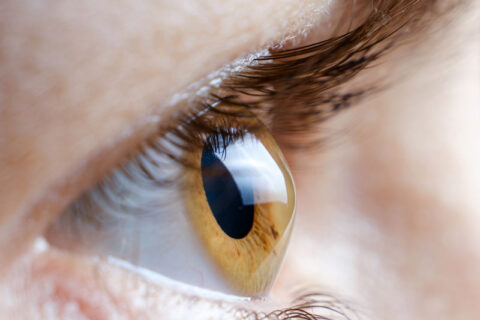 Lentes para ceratocone