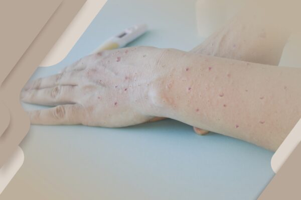 A varíola dos macacos e a saúde ocular