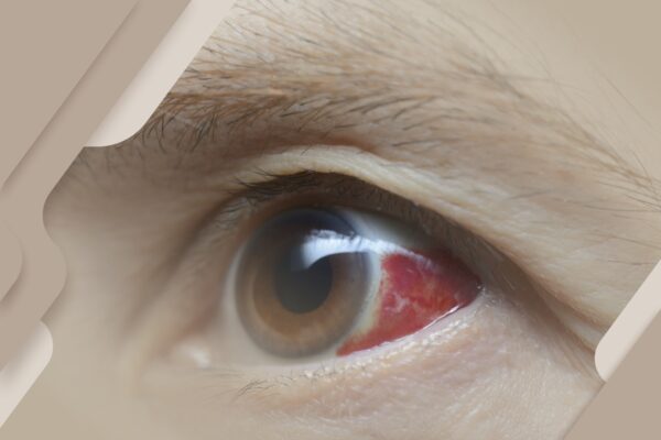 Derrame ocular