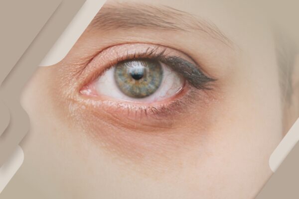 Inchaços e olheiras