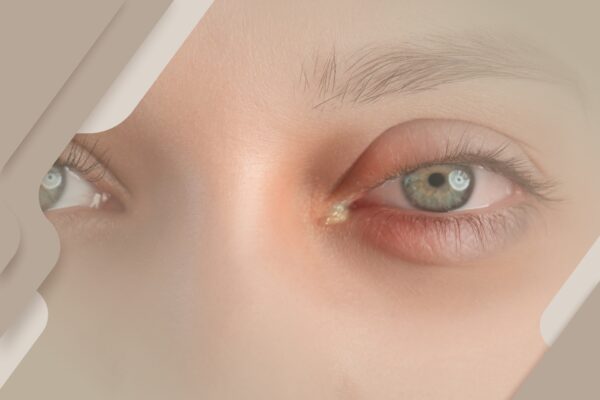 Conjuntivite no verão