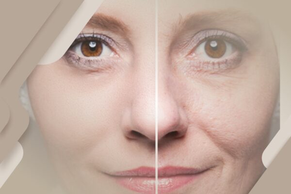 Tudo sobre a blefaroplastia