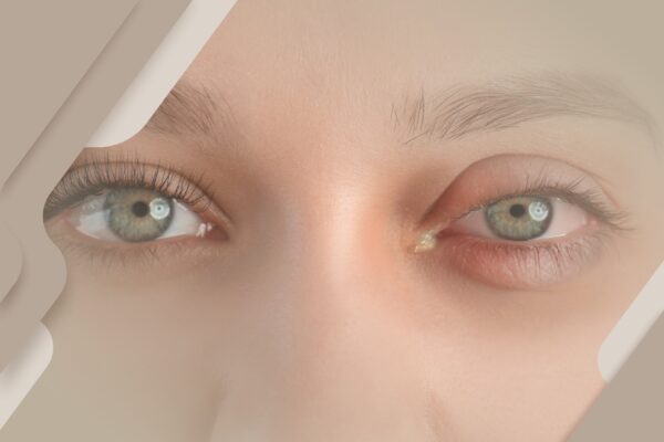 Os diferentes tipos de conjuntivite