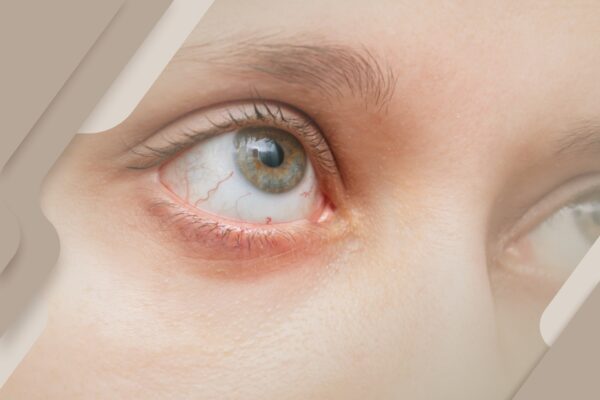 Os incômodos do olho seco