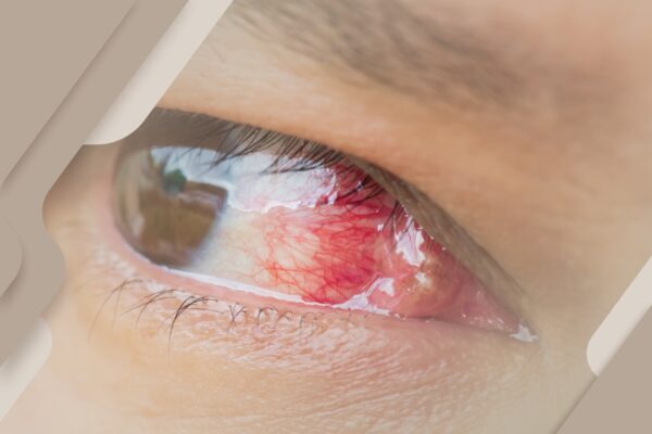 Já ouviu falar em quemose ocular? Entenda!