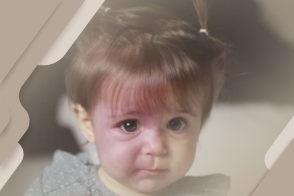 O que é a síndrome de Sturge-Weber?