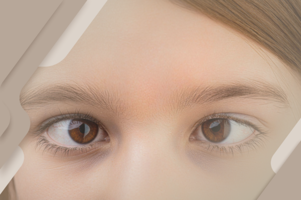 O que é estrabismo?