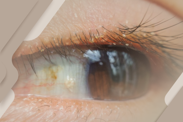 Caspa nos cílios? Descamação pode ser sinal de inflamação nos olhos