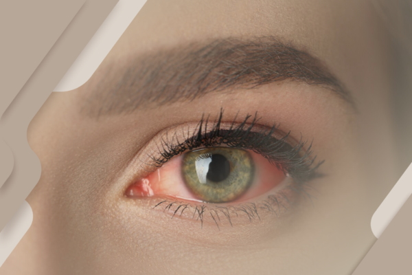 Atriz tem cegueira temporária após uso de pomada capilar. Quais os riscos?