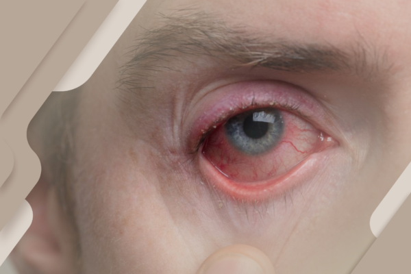Sinais de irritação nos olhos? Não ignore, pode ser conjuntivite