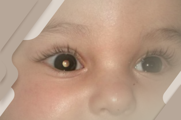 Retinoblastoma: o que você precisa saber sobre esse tipo de câncer raro